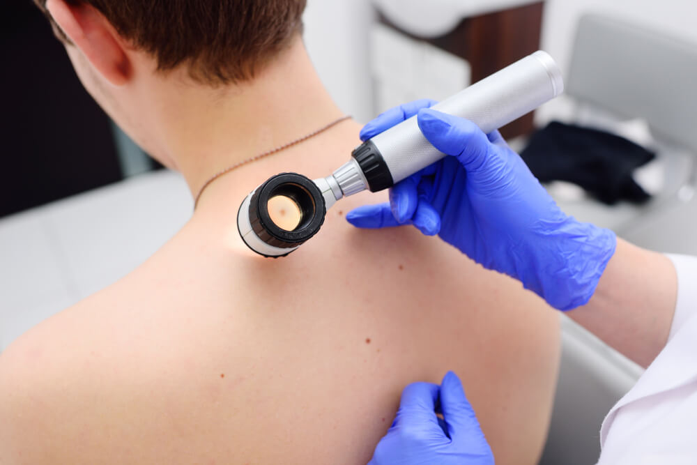 Skin Tag Treatment at Home vs. Clinic